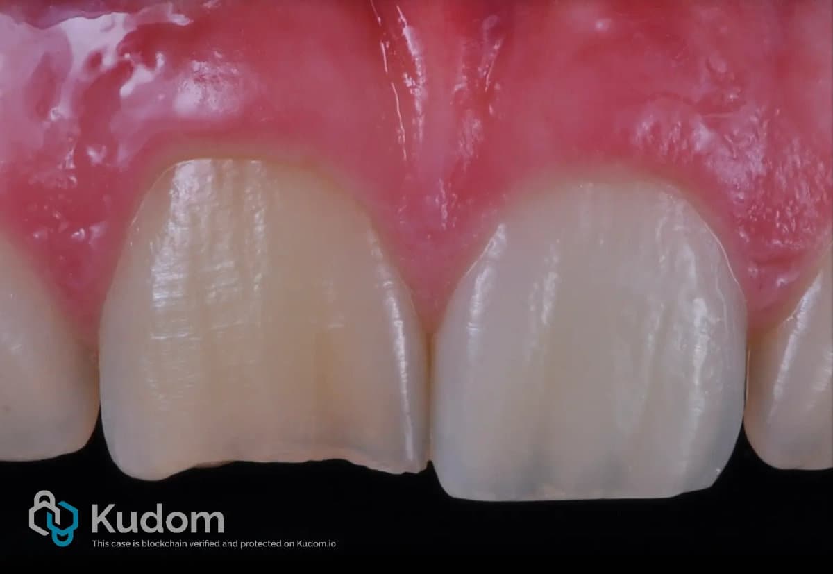 Endodontic clinical case 3