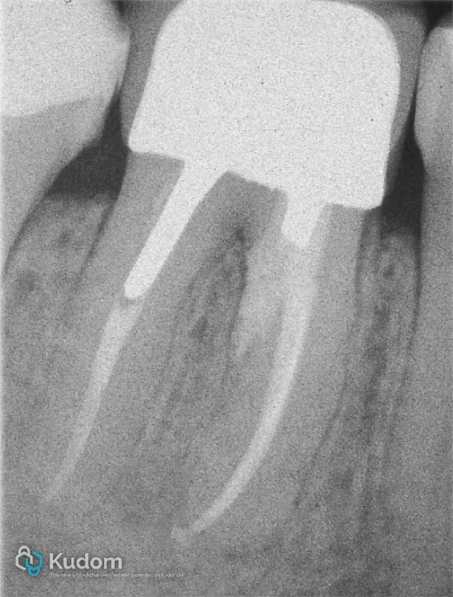 Endodontic clinical case 4