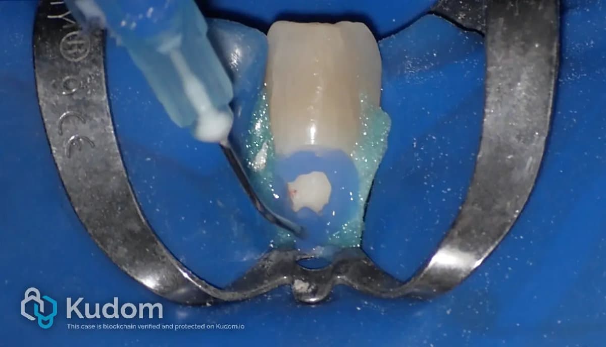 Endodontic clinical case 5