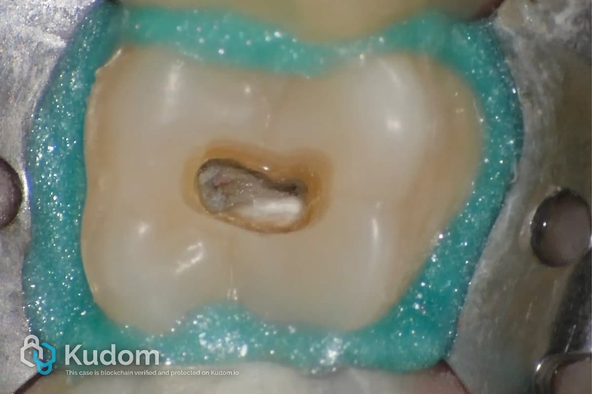 Caso clinico endodontico 1