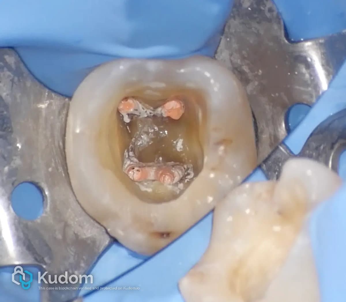 Caso clinico endodontico 2